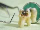 Zwichnięcie i wybicie zębów mlecznych  - przyczyny, objawy, diagnoza, leczenie